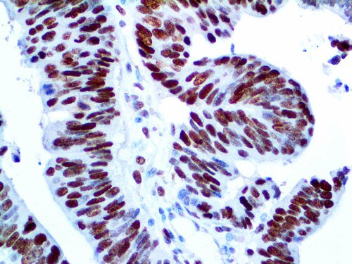 IHC of MCM3 on an FFPE Colon Carcinoma Tissue